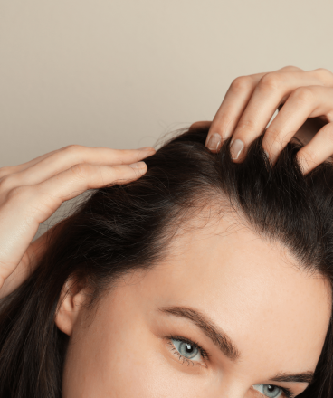 Alopecia Frontal Fibrosante Min